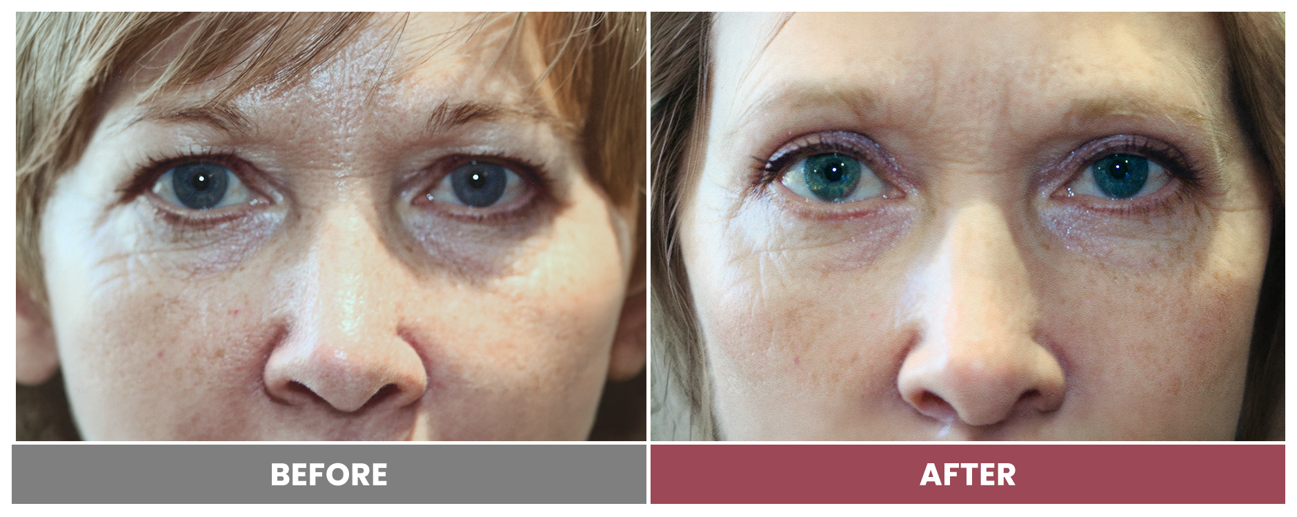 Upper Blepharoplasty - Case 59